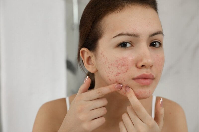 Dị ứng mỹ phẩm là gì?